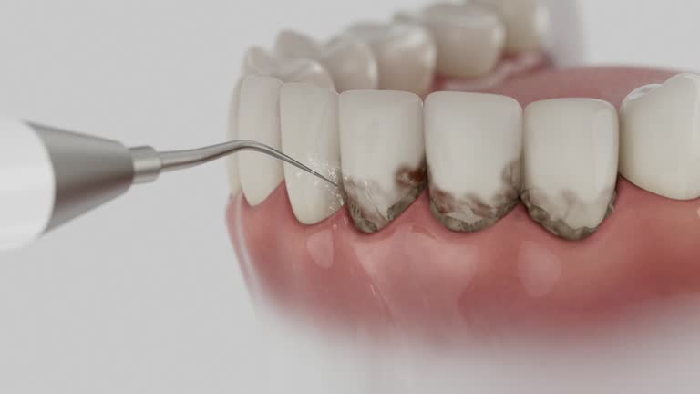 Reliable Tooth Extraction contractor in Burleson, TX by Smile Center Dentistry